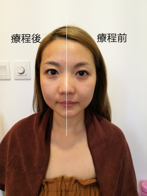 201701-hifu-angel-half-face-2
